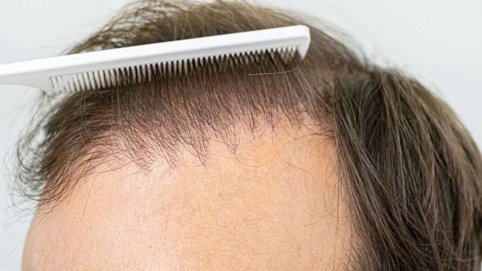 Comb lifting thinning hair at a receding hairline before a repair assessment