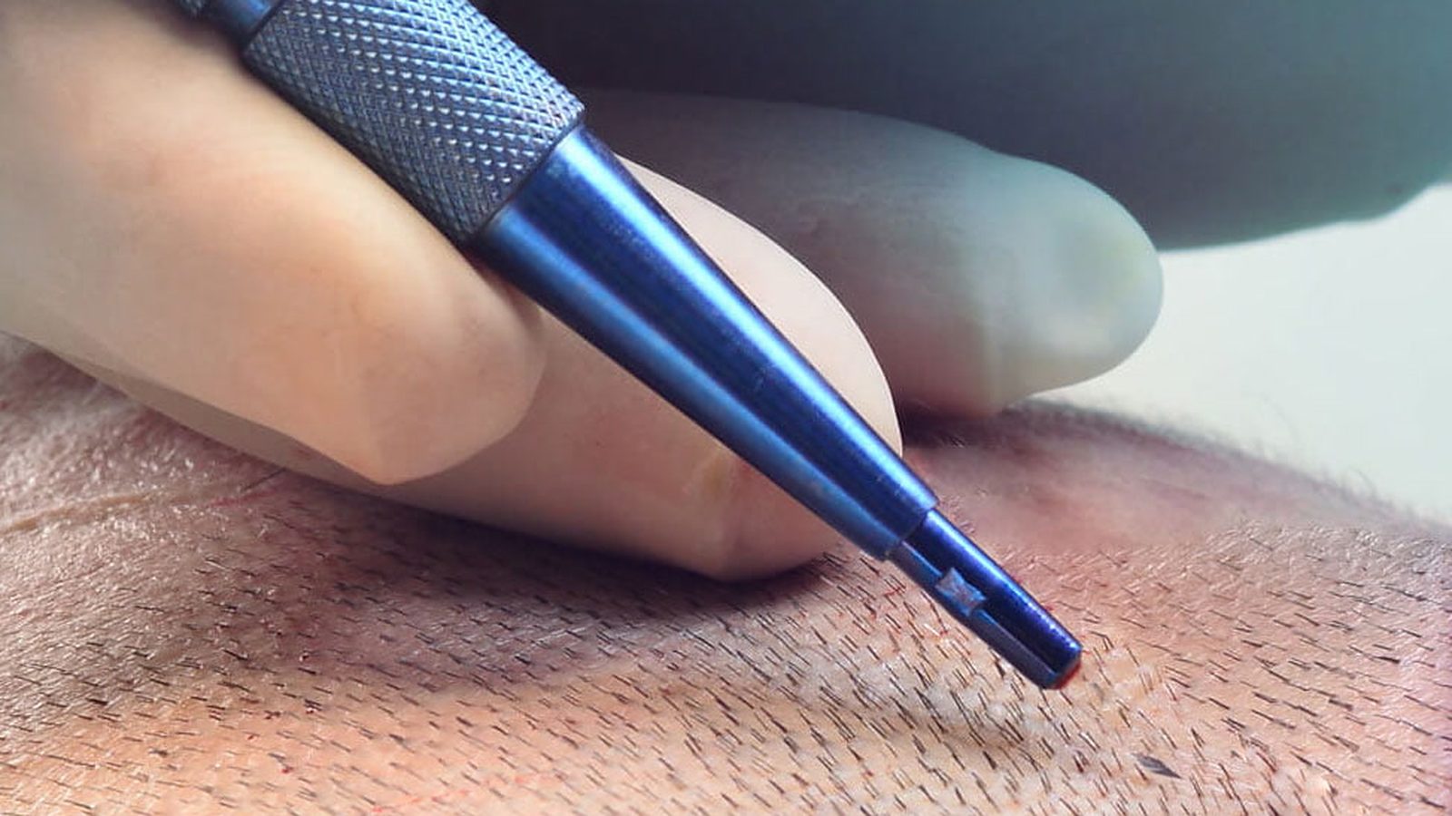 Close-up of a gloved hand holding a fine implanter pen against a shaved scalp during a hair transplant