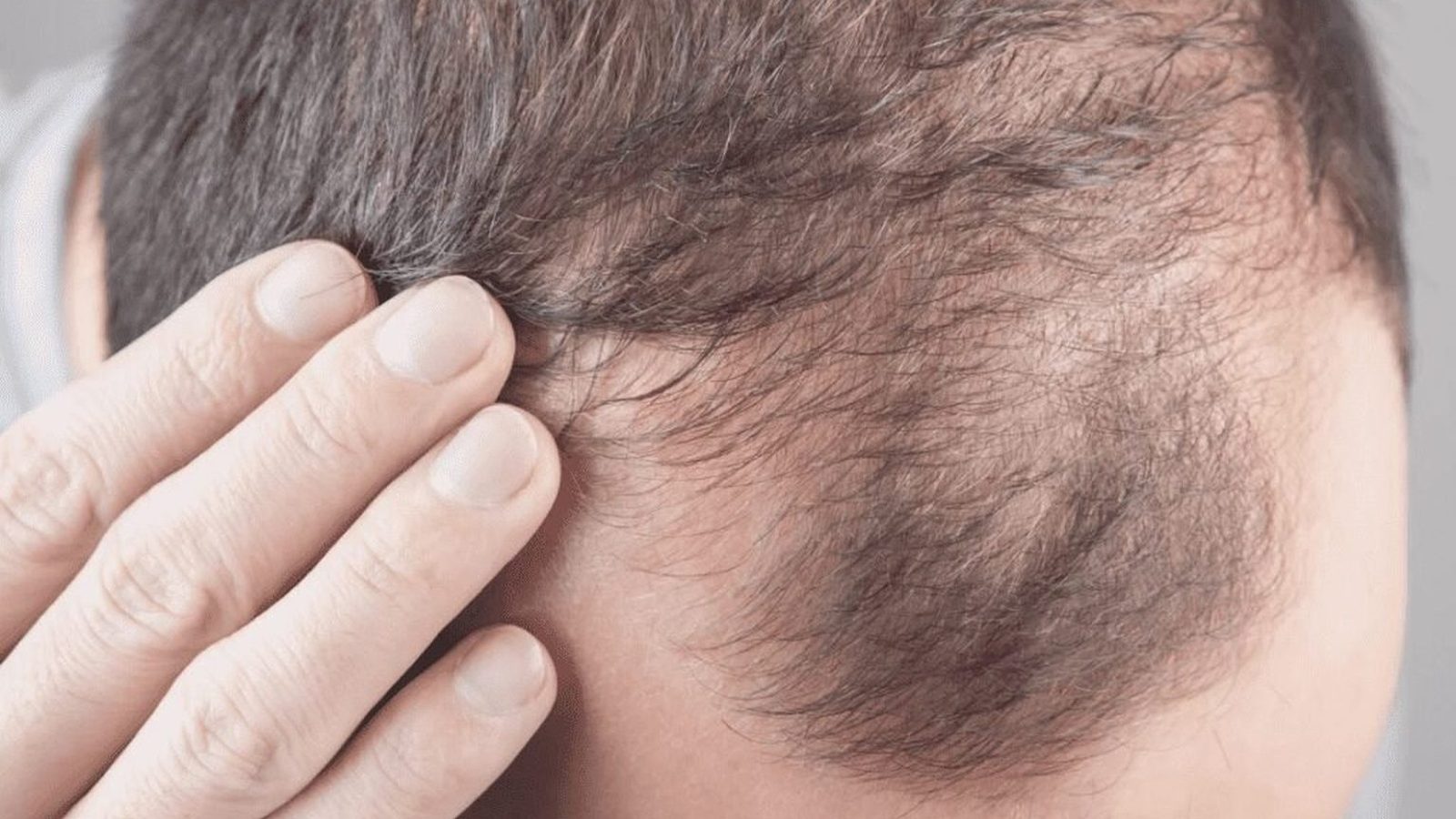 Close-up of a man parting thinning hair on the crown of his head
